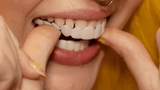BowLift | Instant Smile Transformation with Snap on Smile Veneers