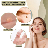 Kalsten | DermaLinx Wart Remover | Pain-Free Removal of Warts & Moles | For Home | Without Surgery