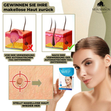 Kalsten | DermaLinx Wart Remover | Pain-Free Removal of Warts & Moles | For Home | Without Surgery