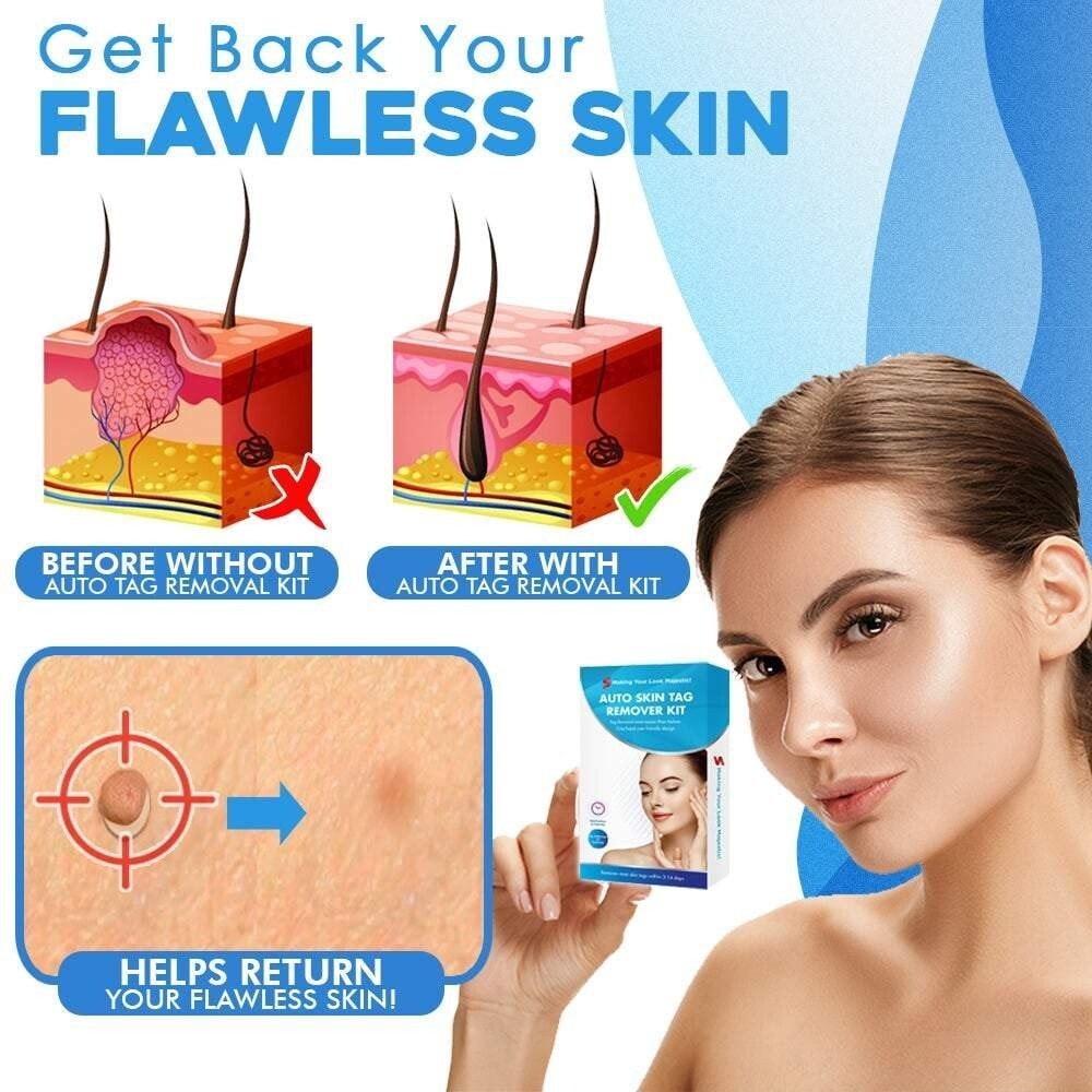 Skin Tag Removal Kit – Ligation Bands, Applicator Tool & No-Cut Method