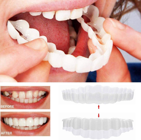 Kalsten | On Smile Veneers (Upper and Lower Jaw included)