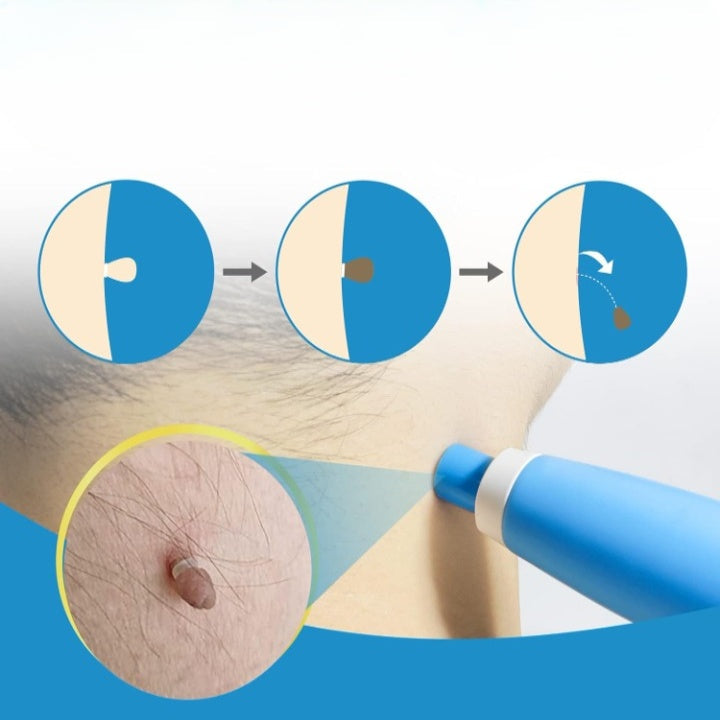 Skin Tag Removal Kit – Painless Micro-Compression, 40 Patches & Two Sizes