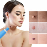 Skin Tag Removal Kit – Painless Micro-Compression, 40 Patches & Two Sizes