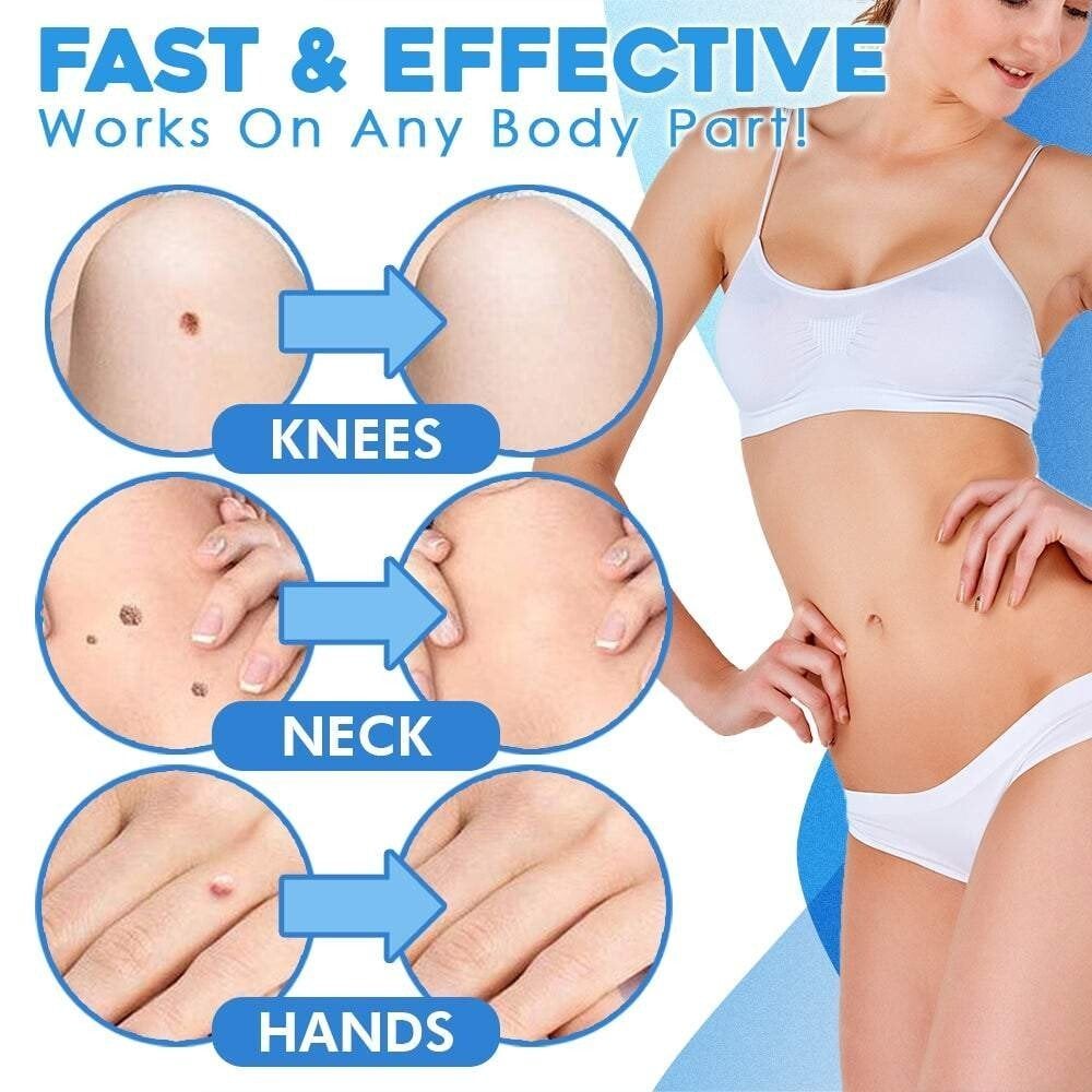 Skin Tag Removal Kit – Ligation Bands, Applicator Tool & No-Cut Method