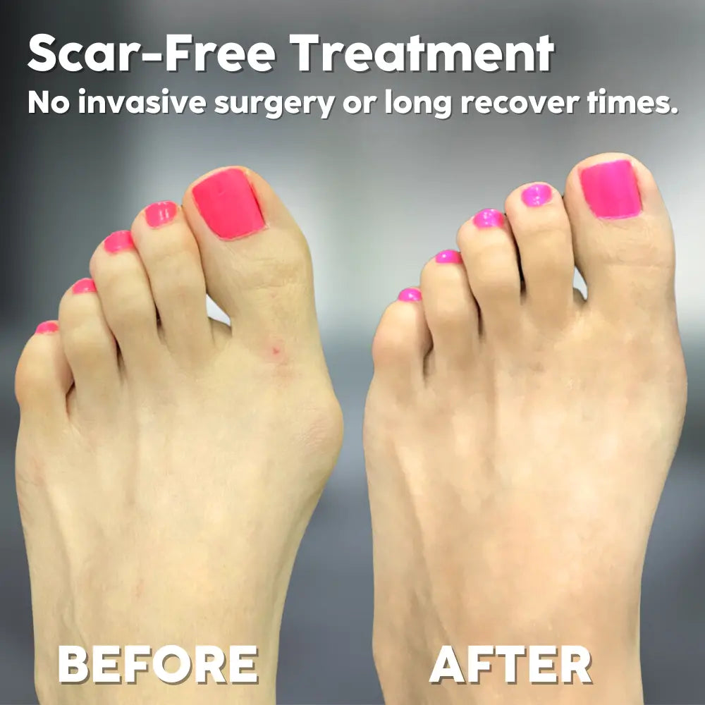 Hallux Valgus Relief - Walk Pain-Free and Confidently | Effective Foot Support Solution