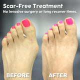 Hallux Valgus Relief - Walk Pain-Free and Confidently | Effective Foot Support Solution