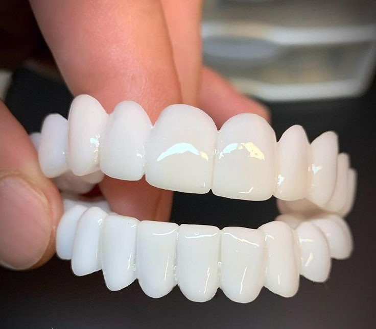 BowLift | DentAlign Dental Veneers – Natural Fit and Comfort