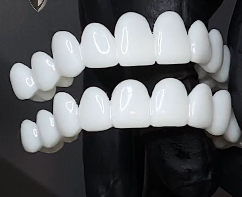 Kalsten | Customizable Dental Prosthesis with Dental Lenses