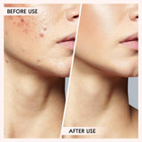 Professional Blackhead & Pimple Extractor Kit - Stainless Steel Acne Removal Tools for Clear Skin