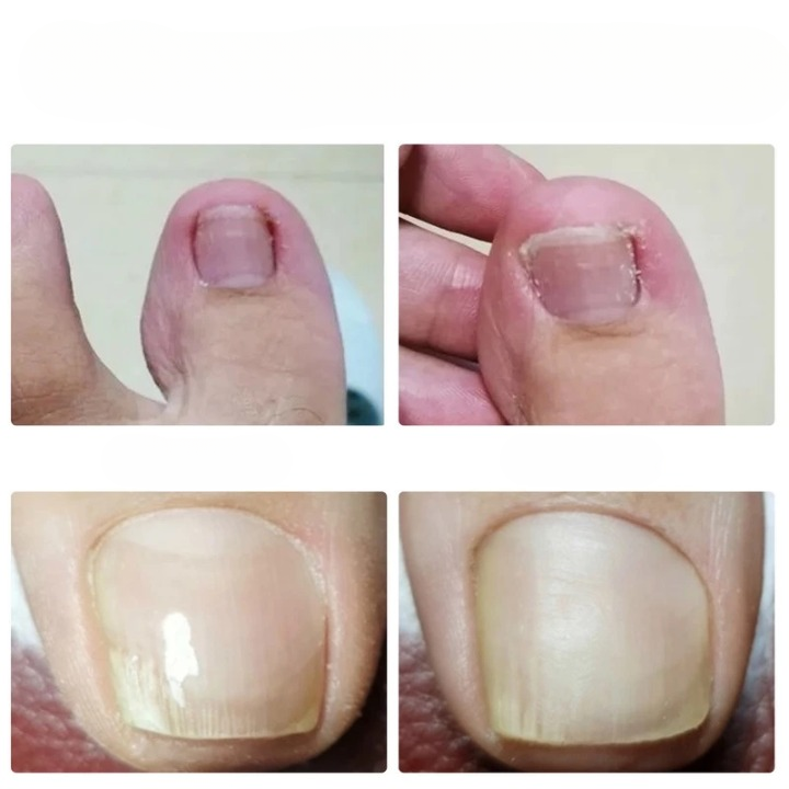 Ingrown Toenail Correction Patches – Painless Lifting, Discreet & Skin-Friendly
