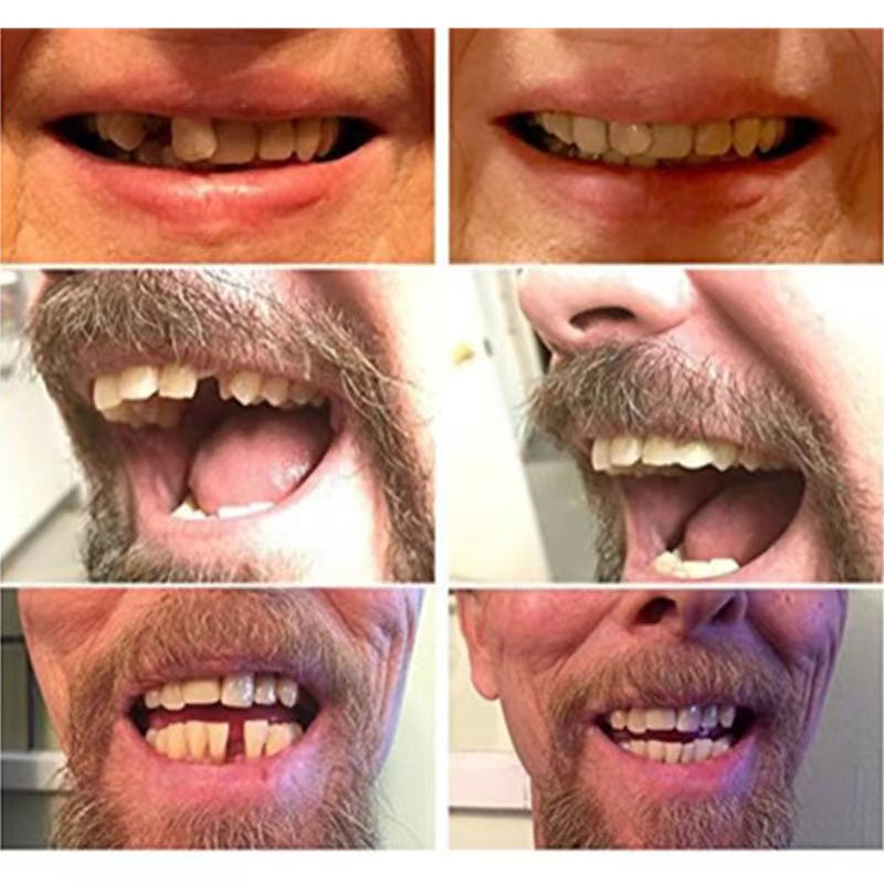 Davy Temporary Cosmetic Dentures - Achieve a Natural Smile Instantly | Comfortable & Affordable Solution