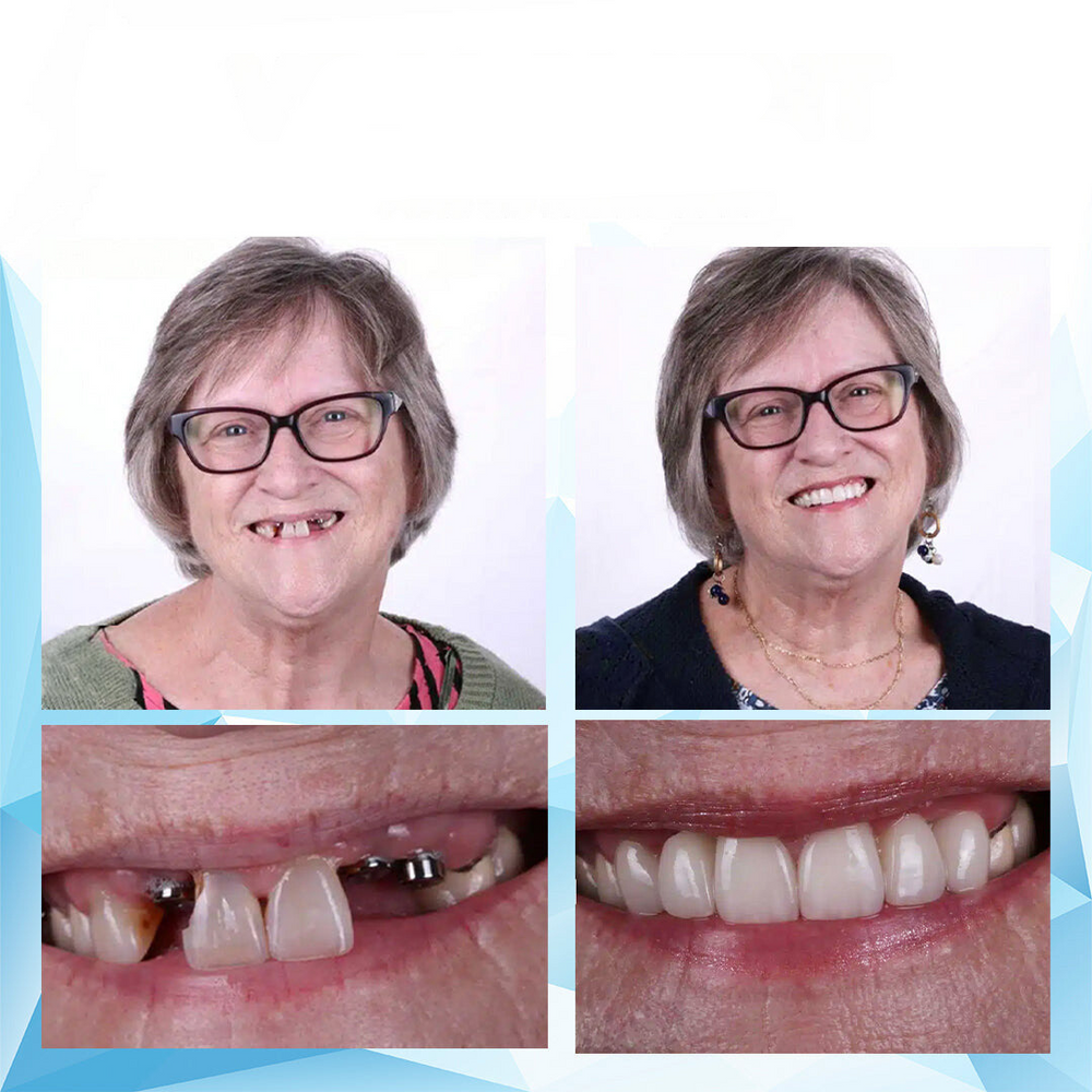 Denture Adhesive Perfect Fit Reline Kit Secure Hold