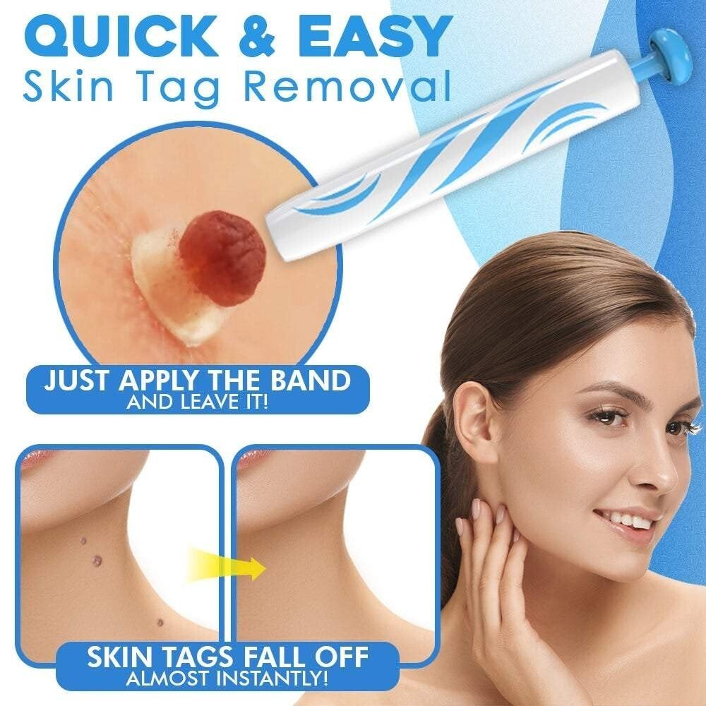 Skin Tag Removal Kit – Ligation Bands, Applicator Tool & No-Cut Method