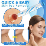 Skin Tag Removal Kit – Ligation Bands, Applicator Tool & No-Cut Method