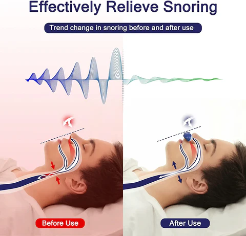 Portable Anti-Snoring Device | Sleep Apnea Relief & Comfortable Sleep Aid