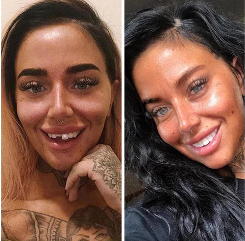 NovaBright Instant Smile Cosmetic Teeth Covers - Effortless Smile Transformation & Confidence Boost