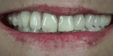NovaBright Instant Smile Cosmetic Teeth Covers - Effortless Smile Transformation & Confidence Boost