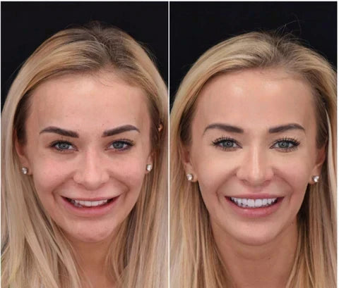 NovaBright Instant Smile Cosmetic Teeth Covers - Effortless Smile Transformation & Confidence Boost