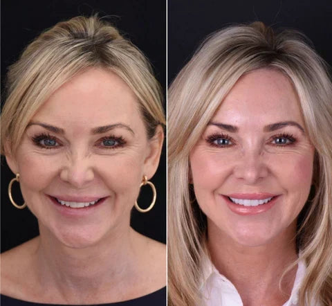 NovaBright Instant Smile Cosmetic Teeth Covers - Effortless Smile Transformation & Confidence Boost