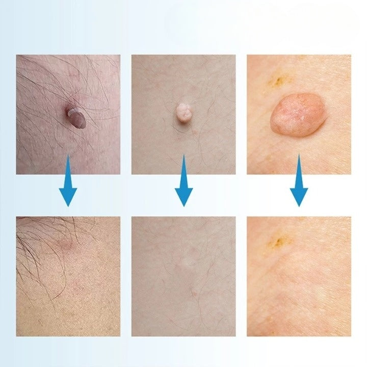 Skin Tag Removal Kit – Painless Micro-Compression, 40 Patches & Two Sizes