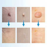 Skin Tag Removal Kit – Painless Micro-Compression, 40 Patches & Two Sizes