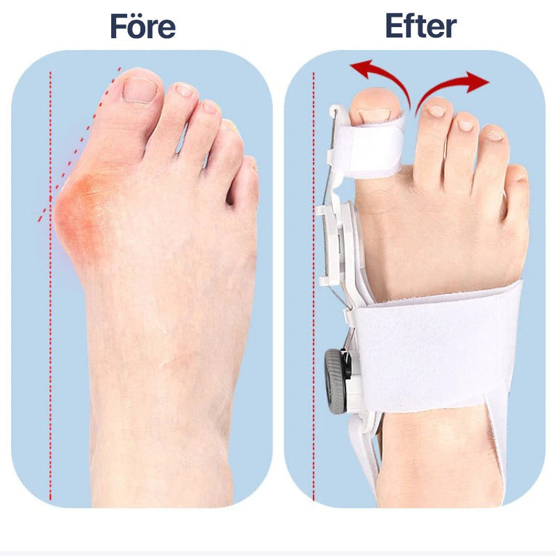 Adjustable Hallux Valgus Big Toe Straightener Brace - Pain Relief & Corrective Support for Bunions