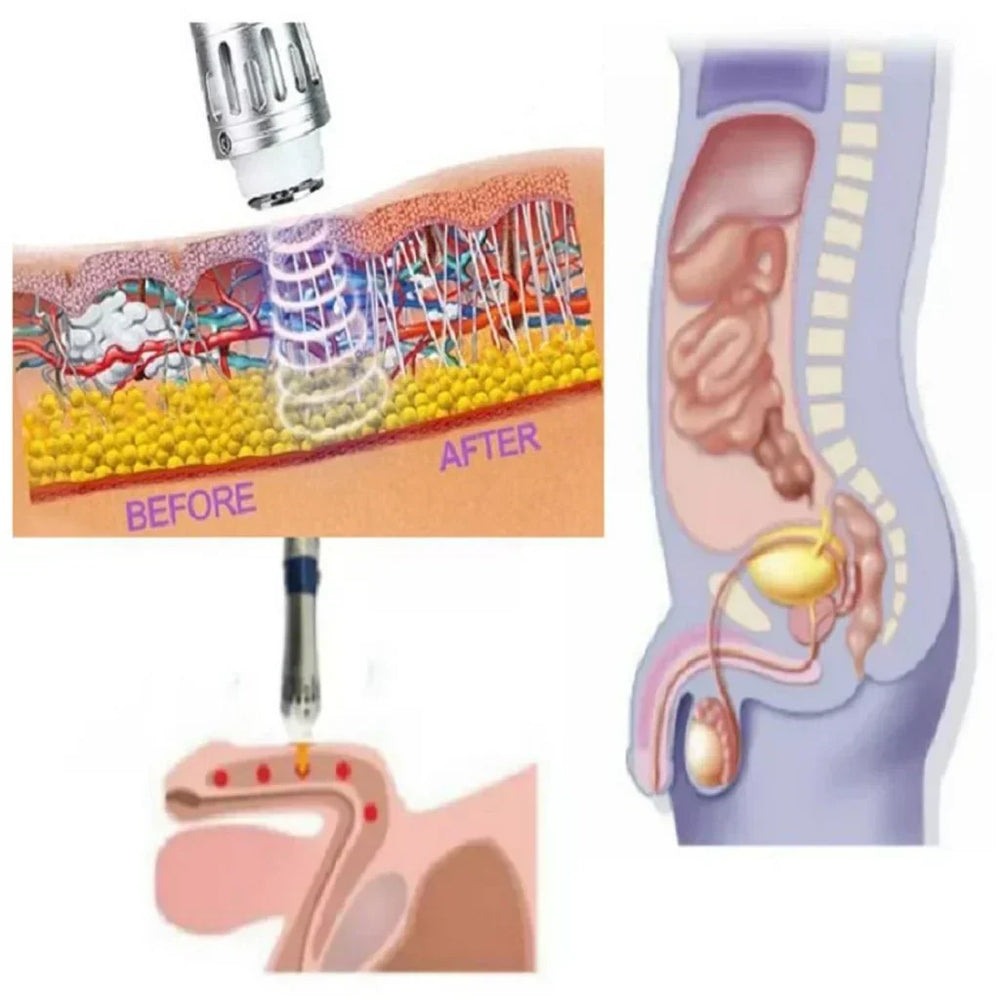 Portable Shockwave Therapy Device for Men's Health - Advanced Pain Relief & Performance Enhancement